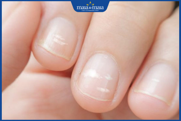 đốm trắng dạng vệt