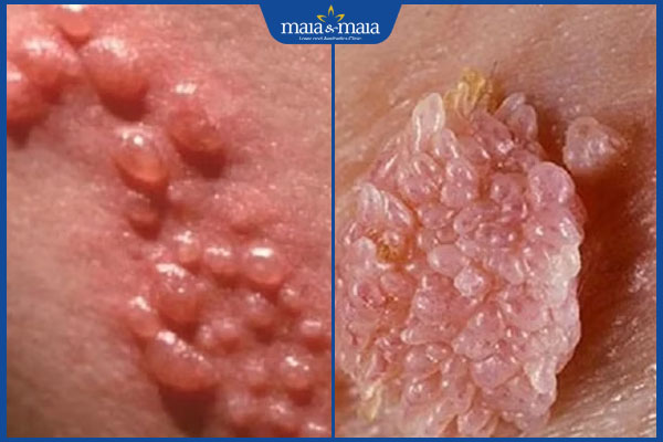 Đốm trắng ở bìu do đâu? Cách chăm sóc điều trị hiệu quả 3 đốm trắng do bệnh lý