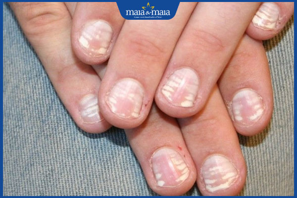 Móng tay có đốm trắng tiềm ẩn bệnh lý gì? Có nguy hiểm không? 3 đốm trắng lan rộng