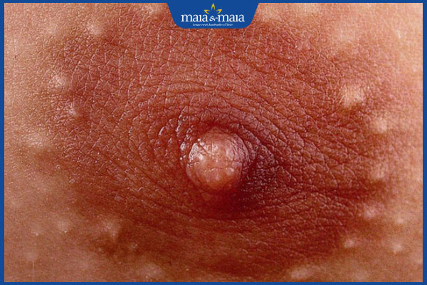 đốm trắng li ti trên nhũ hoa