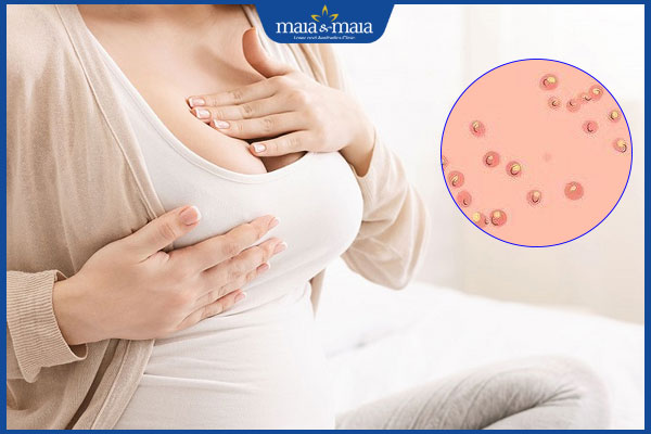 Hướng dẫn cách xử lý nhũ hoa có đốm trắng khi cho con bú 2 đốm trắng ở nhũ hoa