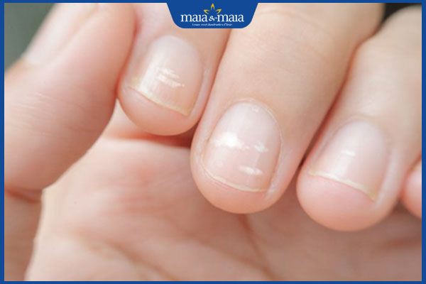 Móng tay có đốm trắng tiềm ẩn bệnh lý gì? Có nguy hiểm không? 2 đốm trắng trên móng tay