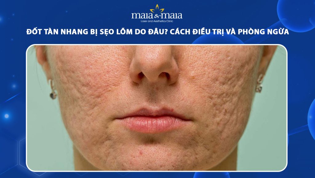 Đốt tàn nhang bị sẹo lõm do đâu? Cách điều trị và phòng ngừa 1 đốt tàn nhang bị sẹo lõm