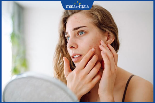 Đốm nâu trên gò má: Nguyên nhân và cách cải thiện hiệu quả 2 gò má xuất hiện đốm nâu