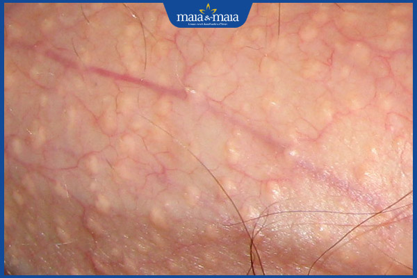 Đốm trắng ở bìu do đâu? Cách chăm sóc điều trị hiệu quả 2 hạt fordyce ở nam