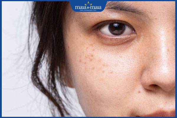 ít đốm tàn nhang