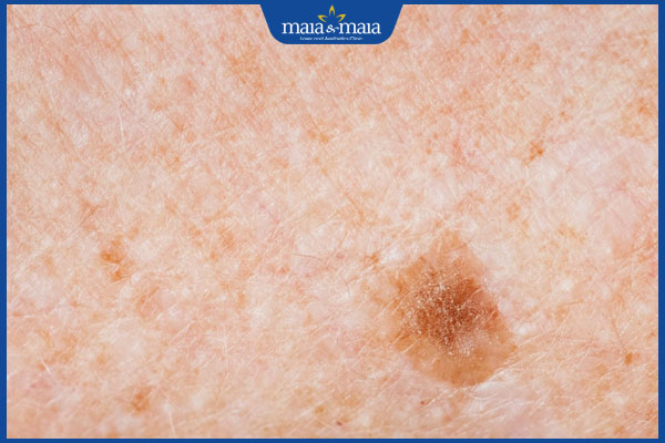 Bác sĩ giải đáp: Đồi mồi ở chân có xóa bỏ dứt điểm được không? 3 kích thước đồi mồi tăng nhanh