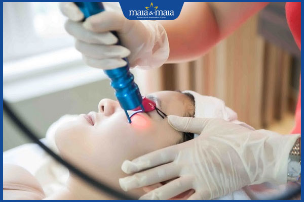 laser trị đồi mồi