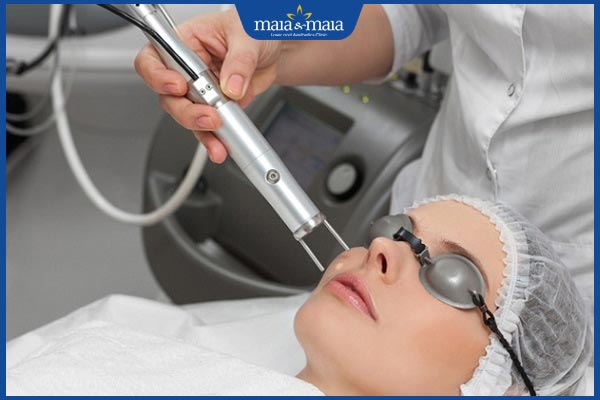 Tàn nhang đỏ: Nguyên nhân gây nên và cách khắc phục hiệu quả 4 laser trị tàn nhang
