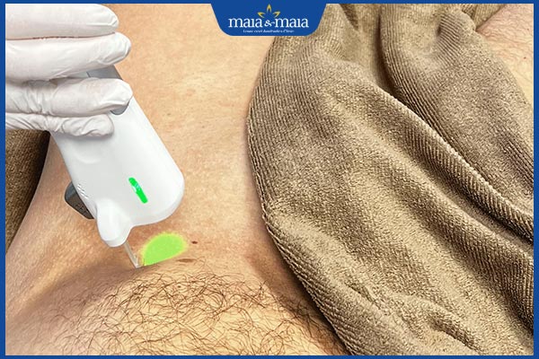 Đốm trắng ở bìu do đâu? Cách chăm sóc điều trị hiệu quả 5 laser vùng kín nam