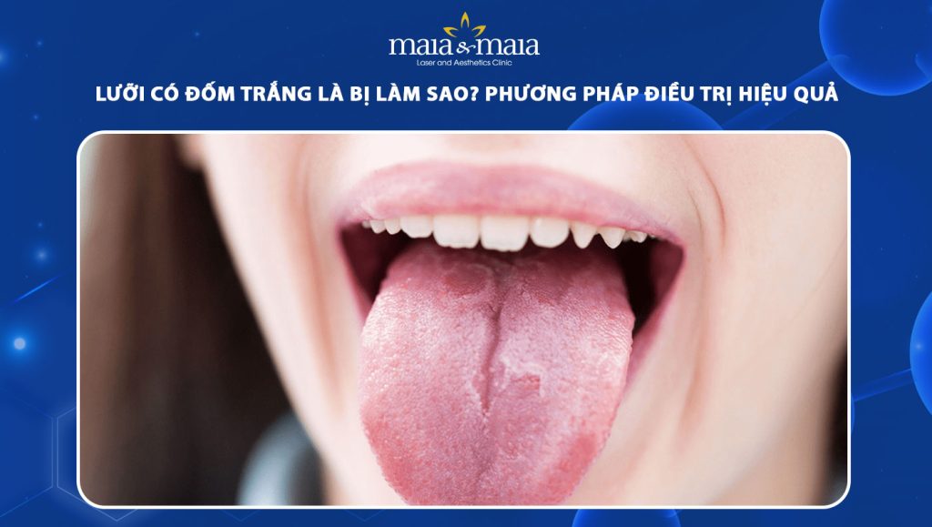 lưỡi có đốm trắng