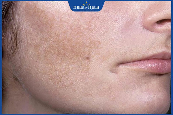 Thế nào là rám má? Gợi ý biện pháp thẩm mỹ hiệu quả tận gốc 2 mảng nâu ở vùng má