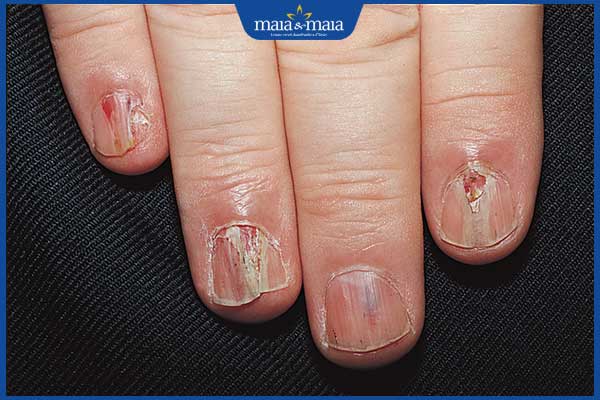 móng tay nhễm nấm