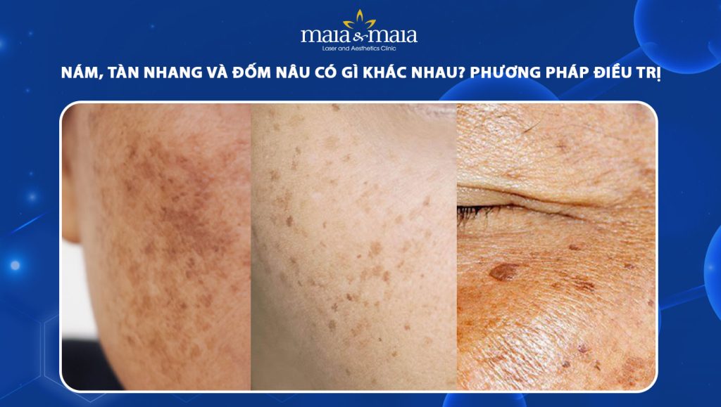 Nám, tàn nhang và đốm nâu có gì khác nhau? Phương pháp điều trị 1 nám tàn nhang và đốm nâu
