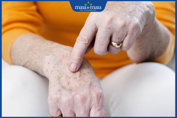 Đồi mồi ở tay: Dấu hiệu, nguyên nhân và cách cải thiện 3 ngứa rát tay do đồi mồi