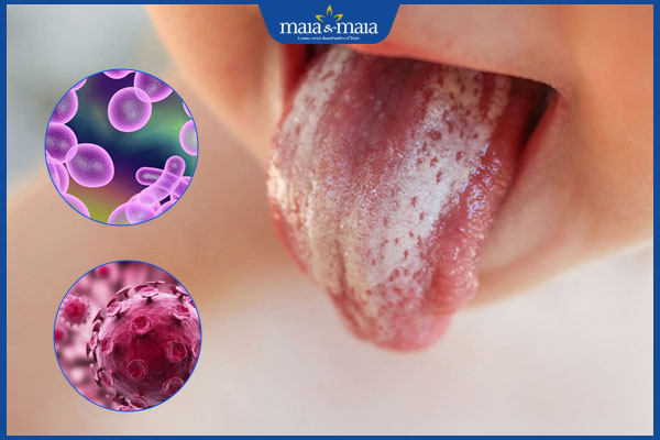 nguyên nhân lưỡi có đốm trắng