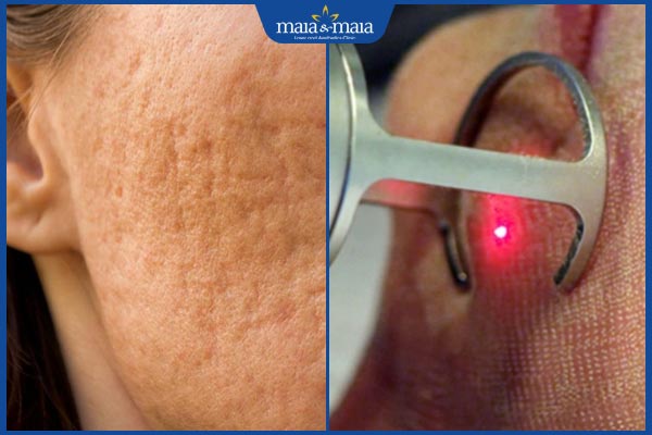 Đốt tàn nhang bị sẹo lõm do đâu? Cách điều trị và phòng ngừa 2 nguyên nhân sẹo lõm sau đốt tàn nhang