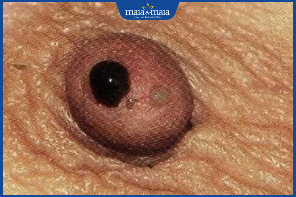 nhũ hoa tiết dịch bất thường