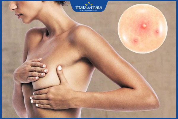 Nhũ hoa có đốm trắng khi mang thai: Nguyên nhân và cách chăm sóc 2 nổi đốm trắng ở nhũ hoa