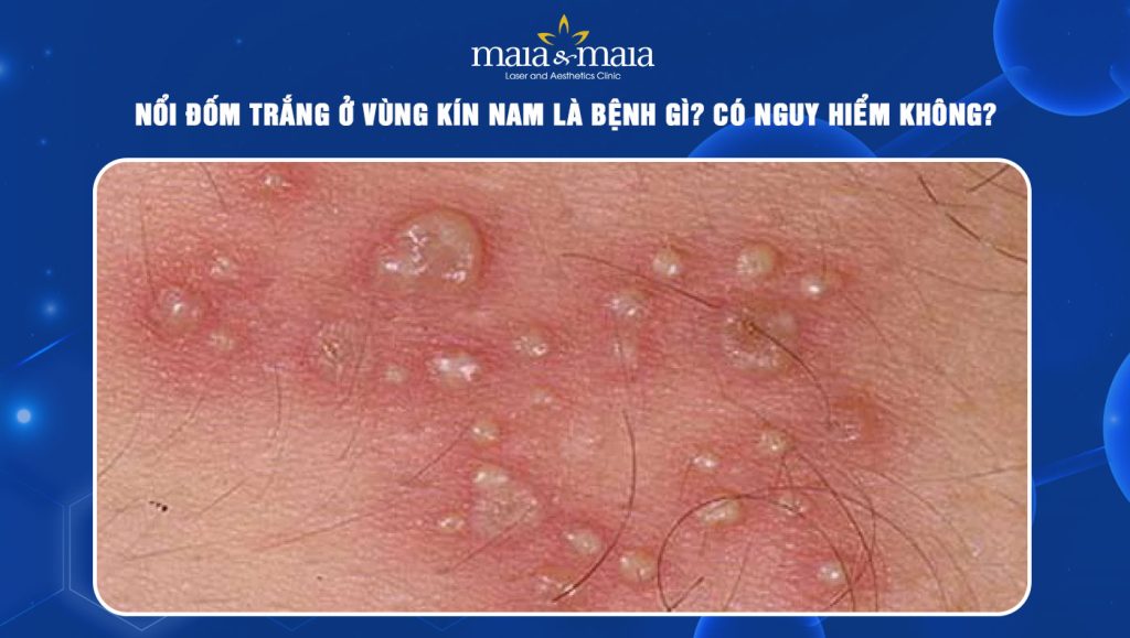 Nổi đốm trắng ở vùng kín nam là bệnh gì? Có nguy hiểm không? 1 nổi đốm trắng ở vùng kín nam