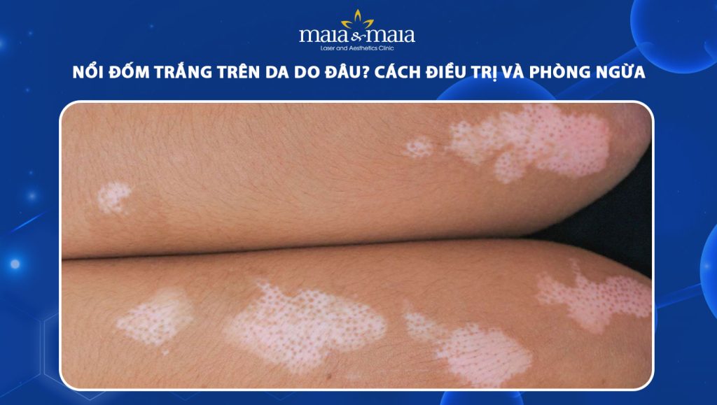 nổi đốm trắng trên da