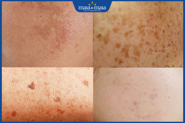 phân biệt các loại đốm nâu