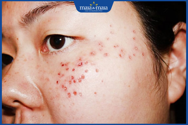 Chấm tàn nhang có hiệu quả không? Giải pháp thay thế ưu việt 2 phương pháp chấm tàn nhang