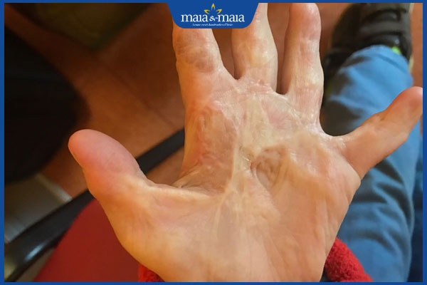 Tổng hợp các loại sẹo phổ biến, nguyên nhân hình thành và cách điều trị 5 sẹo co kéo