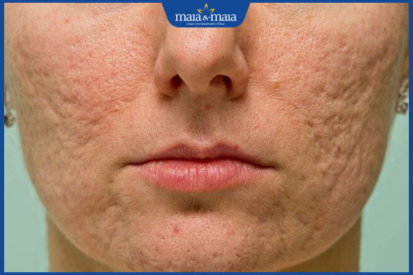 Tổng hợp các loại sẹo phổ biến, nguyên nhân hình thành và cách điều trị 4 sẹo lõm