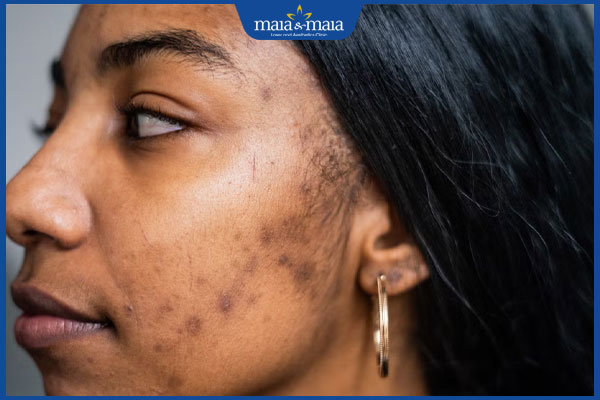 Tổng hợp các loại sẹo phổ biến, nguyên nhân hình thành và cách điều trị 6 sẹo thâm