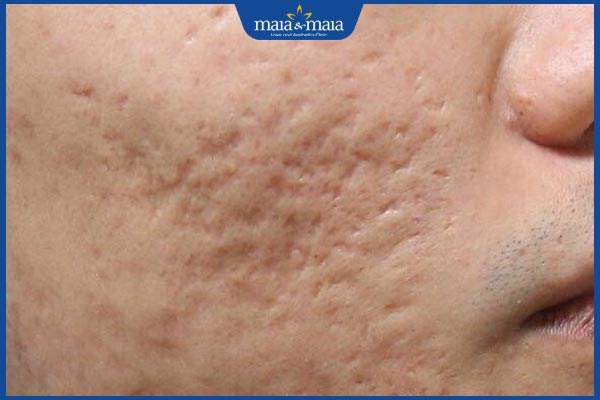 Tổng hợp các loại sẹo phổ biến, nguyên nhân hình thành và cách điều trị 2 sẹo