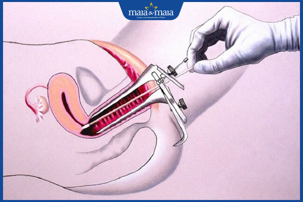 Đốm trắng ở vùng kín nữ do nguyên nhân nào? Có nguy hiểm không? 3 sinh thiết