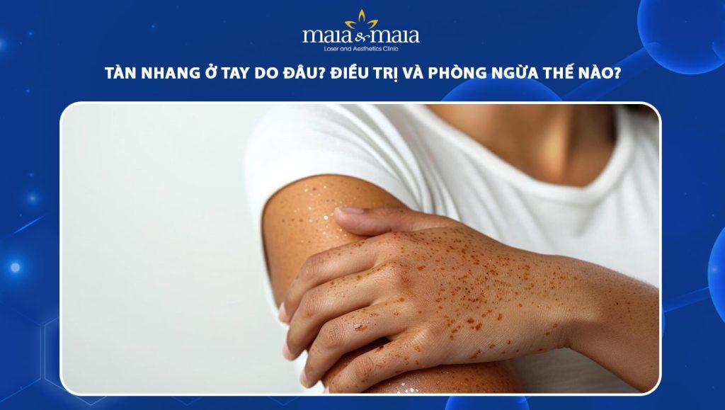 Tàn nhang ở tay do đâu? Điều trị và phòng ngừa thế nào? 1 tàn nhang ở tay