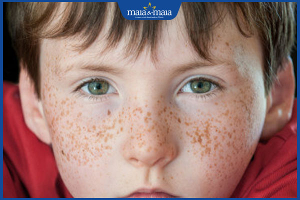 Thế nào là tàn nhang bẩm sinh? Làm sao để xóa bỏ triệt để? 2 tàn nhang từ nhỏ