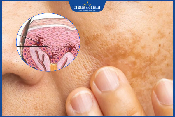 Thức đêm gây sạm da phải làm sao? Địa chỉ điều trị uy tín 2 tăng sinh melanin