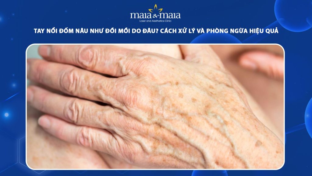 tay nổi đốm nâu như đồi mồi