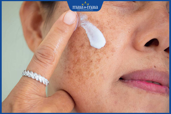 Thế nào là rám má? Gợi ý biện pháp thẩm mỹ hiệu quả tận gốc 4 thuốc bôi thoa điều trị