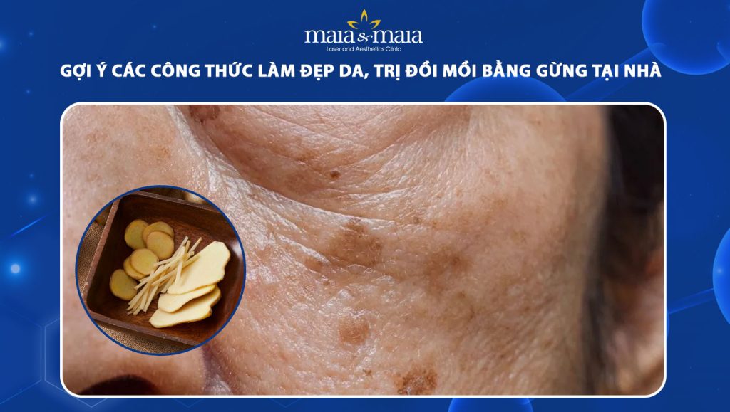 trị đồi mồi bằng gừng