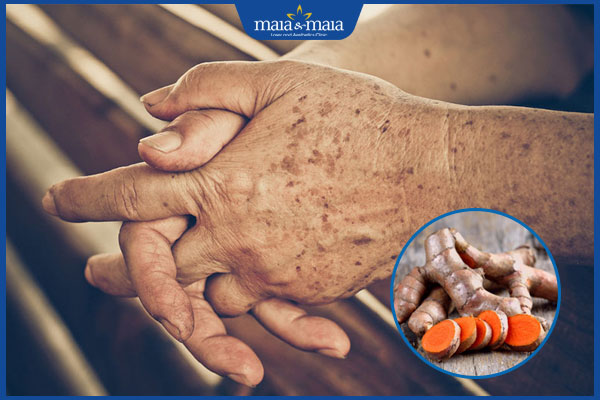 Đồi mồi ở tay: Dấu hiệu, nguyên nhân và cách cải thiện 4 trị đồi môi ở tay bằng nghệ tươi