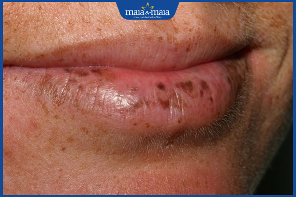 xuất hiện đốm đen sau phun môi