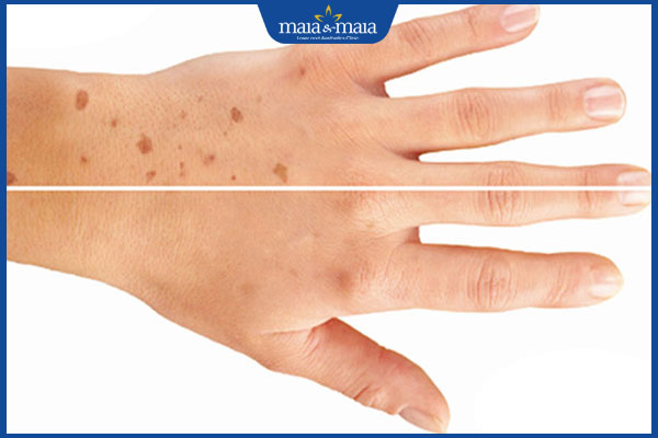 Đồi mồi ở tay: Dấu hiệu, nguyên nhân và cách cải thiện 2 xuất hiện đốm nâu ở tay