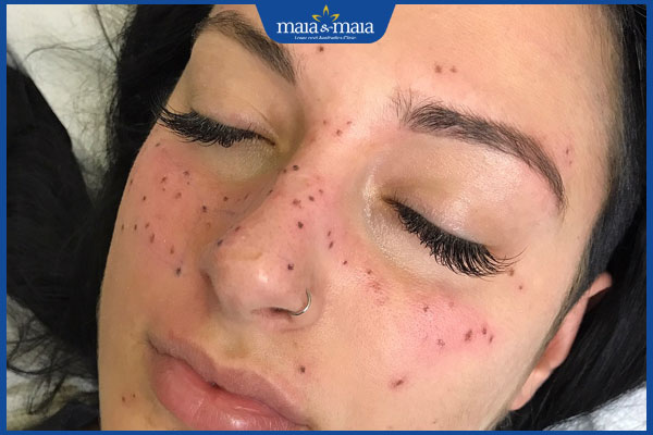 xuất hiện sẹo xấu sau tàn nhang