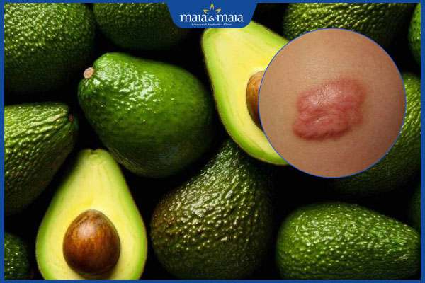 Ăn bơ có bị sẹo lồi không? Gợi ý thực phẩm giúp giảm sẹo 2 ăn bơ