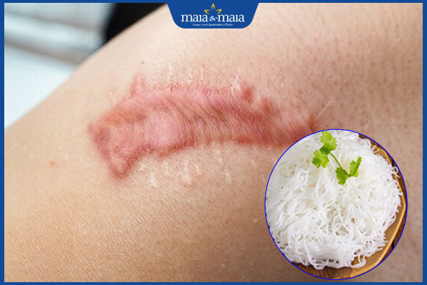 Ăn bún có bị sẹo lồi không? Cách xây dựng chế độ ăn uống khoa học 2 ăn bún