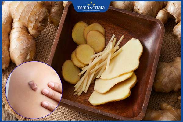 Ăn gừng có bị sẹo lồi không? Chế độ dinh dưỡng hỗ trợ phục hồi 2 ăn gừng để lại sẹo lồi