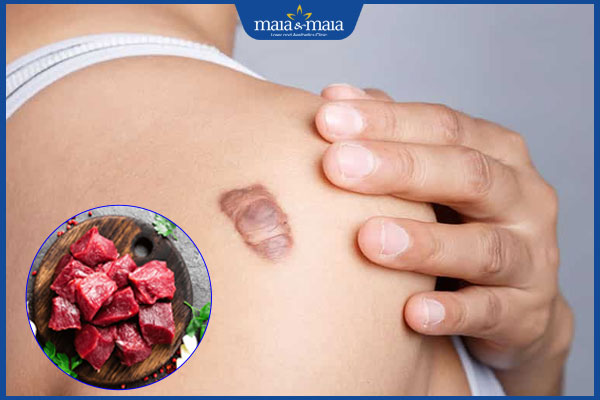 ăn thịt bò để lại sẹo