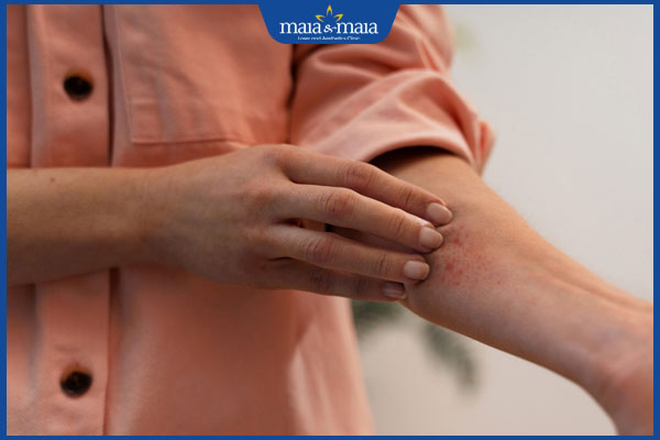 ăn tôm gây ngứa da