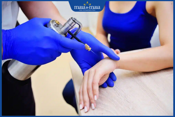 Trị sẹo lồi bằng nitơ lỏng có đắt không? Hiệu quả ra sao? 2 áp lạnh nitơ lỏng