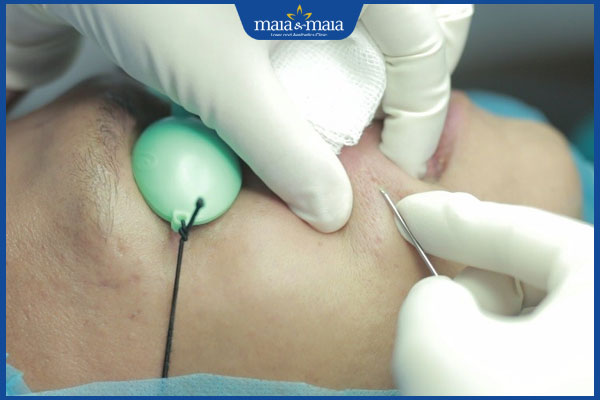 bóc tách đáy sẹo