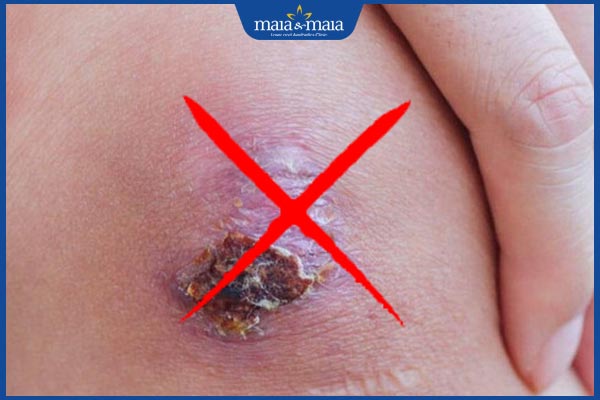 Kiêng ăn gì để không bị sẹo lồi? Thực phẩm nên ưu tiên khi bị thương 5 bóc vảy vết thương